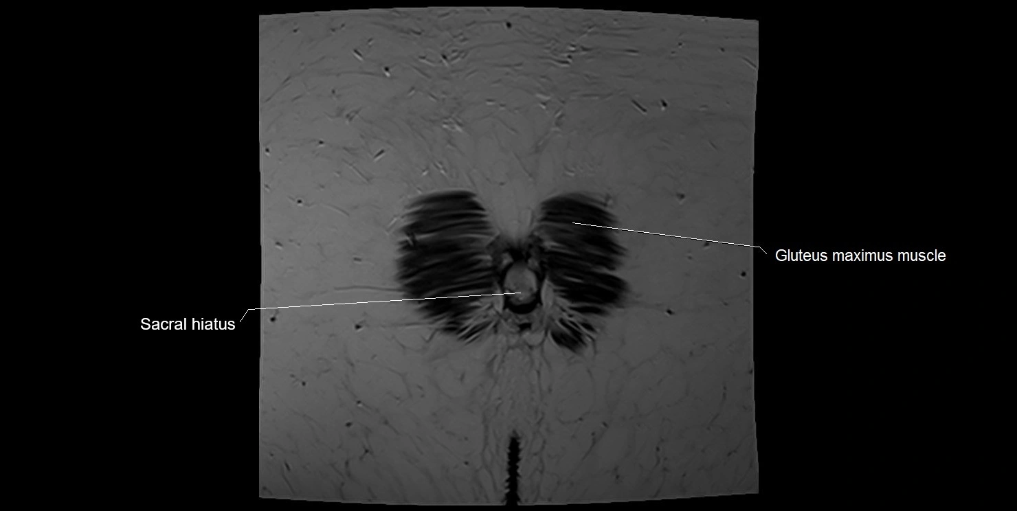 female pelvis coronal cross sectional anatomy image 39.webp